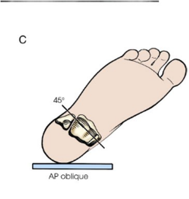<p>AP Oblique</p>