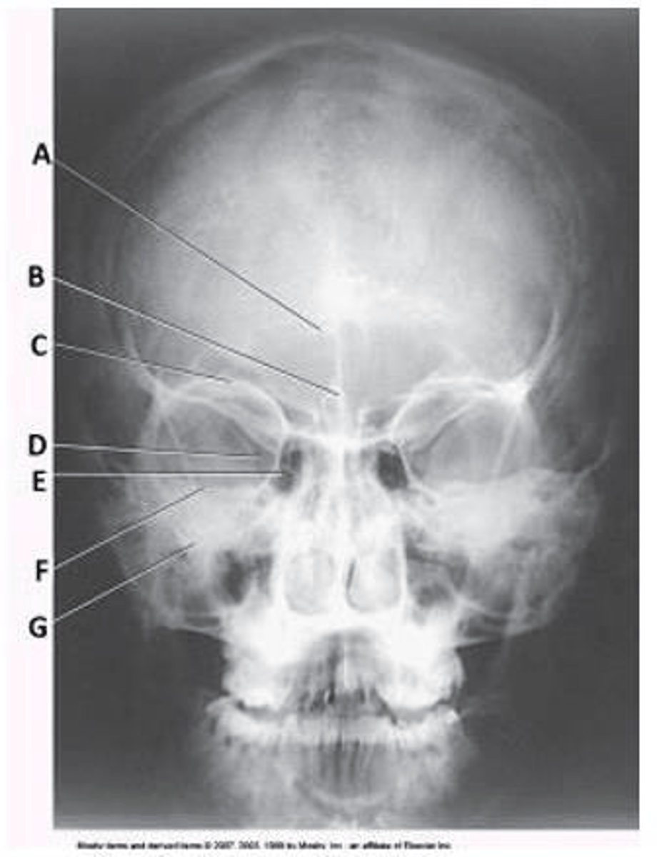<p>a. PA axial (Caldwell)</p>
