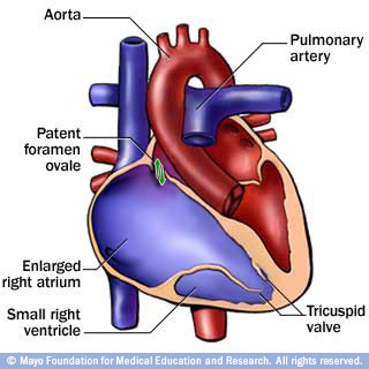 <p>Tricuspid flaps fused to inside of right ventricle; creates constant opening between atrium &amp; ventricle</p>