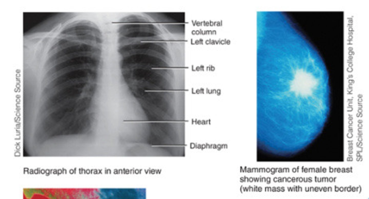<p>A single barrage of x-rays used to produce images through the body, useful for examining the breast and for determining bone density</p>
