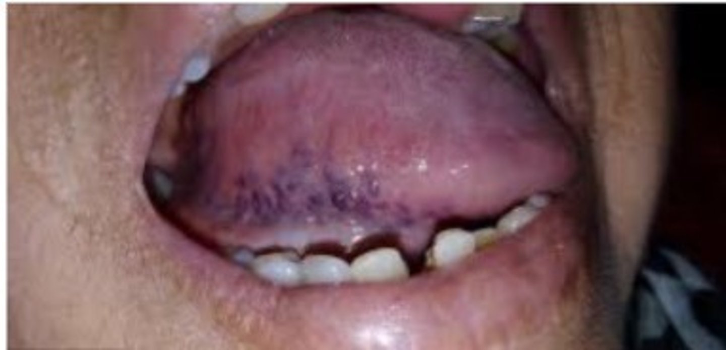 <p>What is the most common type of Varicosities? </p>