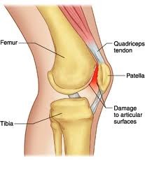 a painful degenerative condition that results in the irritation and softening of the articular cartilage on the posterior patella