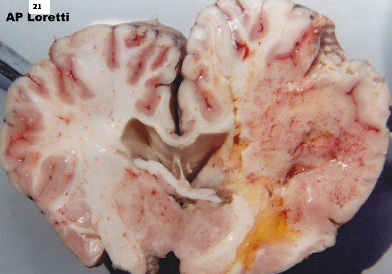 <p>21.<span>&nbsp; </span>Tissue from a horse.<span>&nbsp; </span>Which of the following is NOT true?</p><ol type="a"><li><p>Associated lesions in the brainstem and spinal cord are present within the grey matter.</p></li><li><p>Liver lesions may accompany brain lesions.</p></li><li><p>Swine affected by this toxin have myocardial necrosis.</p></li><li><p>Both sphingosine and sphinganine are elevated in affected animals.<span>&nbsp;</span></p></li></ol><p></p>