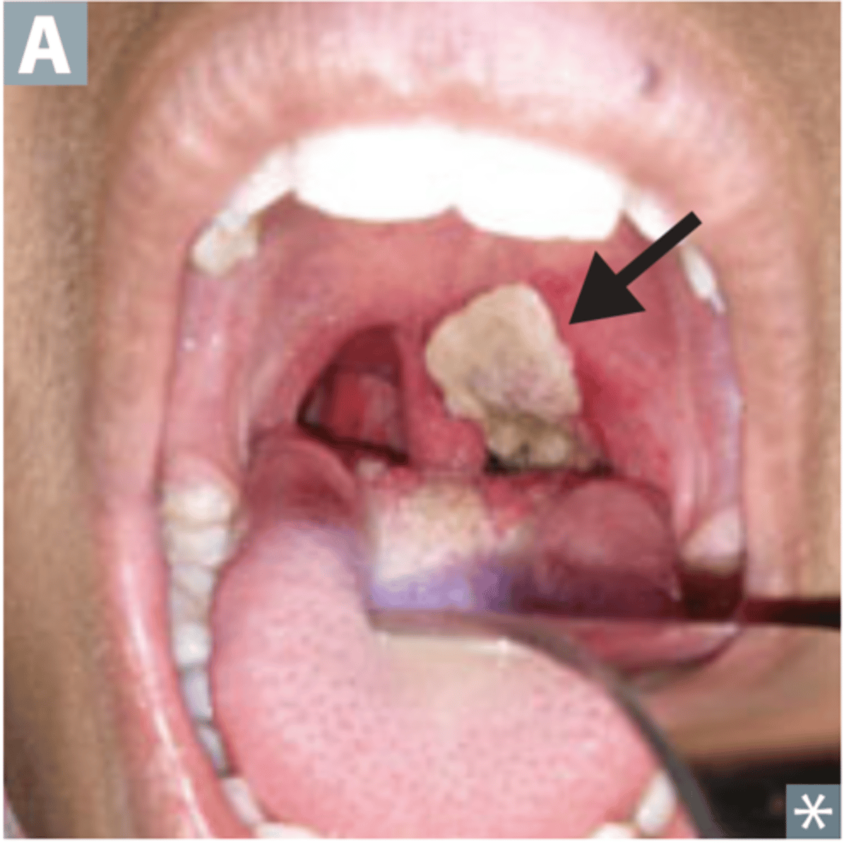 <p>A layer of exudate resembling a membrane, made of dead cells and bacteria --&gt; causes severe airway obstruction, death</p>