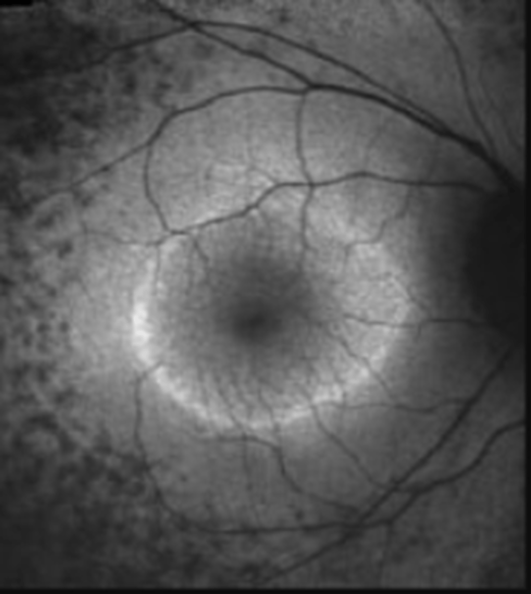 <p>ring of hyperAF encircles fovea due to increased lipofuscin in RPE (PR degeneration)</p><p>hypoAF in periphery due to RPE atrophy</p>
