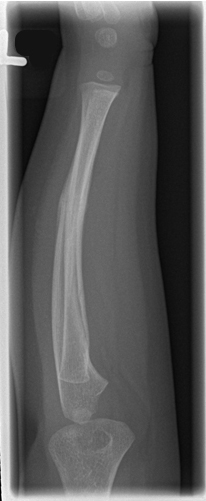 <p>What causes a bow deformity?</p>