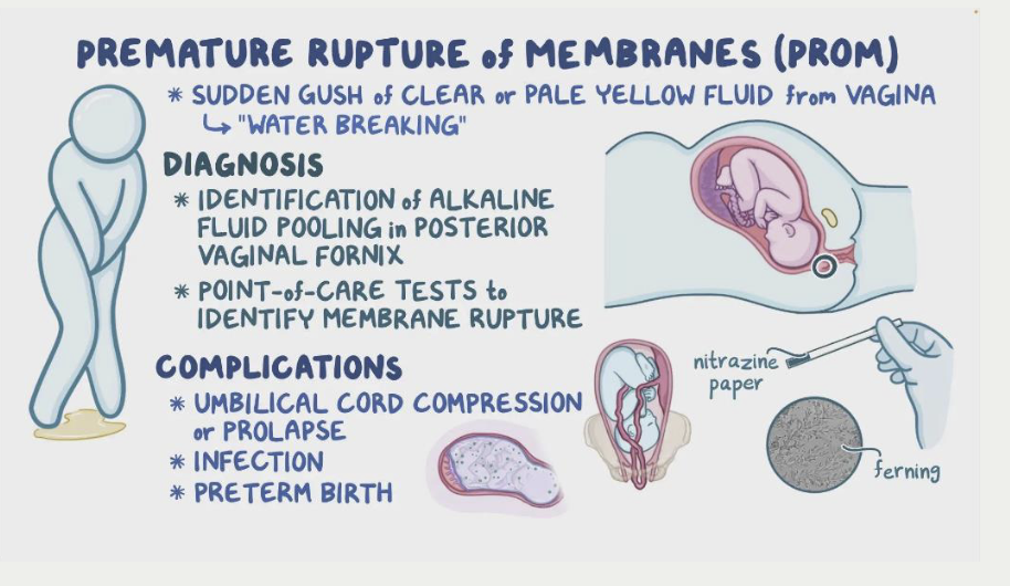 <p>Rupture of membranes before labor begins and less than 37 weeks</p><p><strong>symptoms</strong></p><ul><li><p>sudden gush or slow leak of fluid</p></li><li><p>can feel like peeing without control</p></li></ul><p><strong>Diagnosis</strong></p><ul><li><p>symptoms, obvious presence of fluid, amniotic fluid test</p></li></ul><p><strong>primary complication</strong></p><ul><li><p><strong><u>infection</u></strong></p></li></ul><p><strong>management</strong></p><ul><li><p>between 34-37 weeks —&gt; delivery</p></li><li><p>less than 32 weeks, expectant management</p><ul><li><p>hospitalized, routine monitoring with NST</p></li><li><p>magnesium sulfate glucocorticoids</p></li><li><p>antibioitcs x7 days - ampicillin, amoxicillin or erythromycin</p></li></ul></li></ul><p></p>