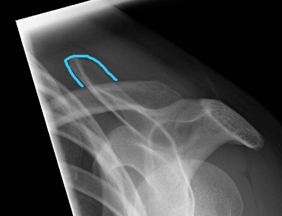 <p>elbow</p><ul><li><p>flexed at 90degrees</p></li></ul><p>waist</p><ul><li><p>SSA is SI or slightly superior to clavicle</p></li></ul><p></p>