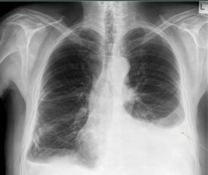 <p>What pathology is seen on this x-ray?</p>
