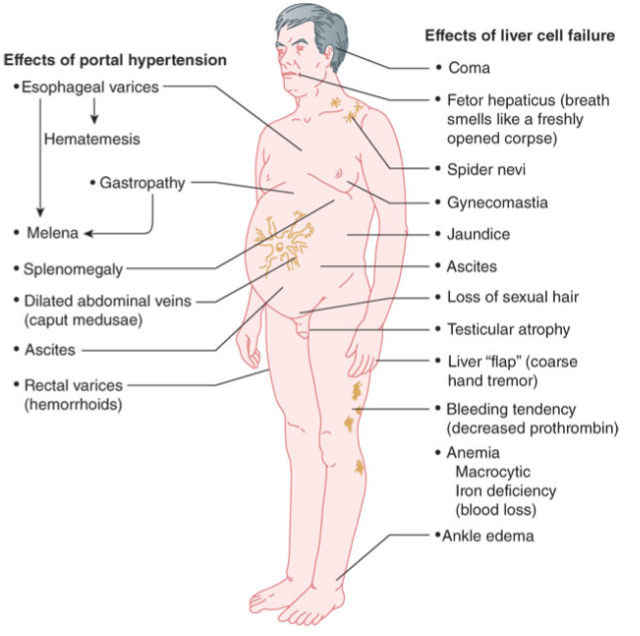 <p>In cirrhosis, portal hypertension occurs and the blood is diverted around the liver rather than being filtered through the liver. This phenomenon, termed portal-to-systemic (or portosystemic) shunting</p>