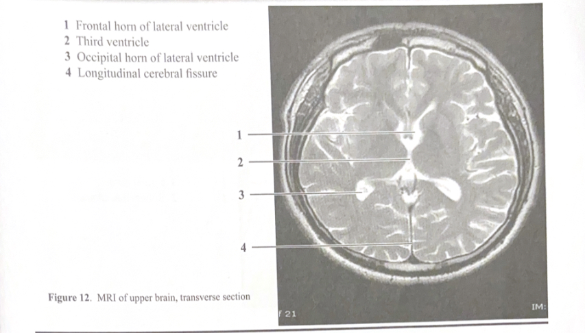 <ol><li><p>Frontal horn of lateral ventricle&nbsp;</p></li><li><p>Third ventricle&nbsp;</p></li><li><p>Occipital horn of lateral ventricle&nbsp;</p></li><li><p>Longitudinal cerebral fissure&nbsp;</p></li></ol><p></p>