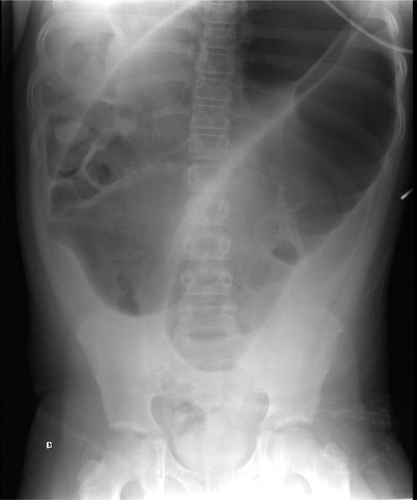 <p>Identify the radiography appearance and define the pathology. Provide patient’s symptoms.</p>