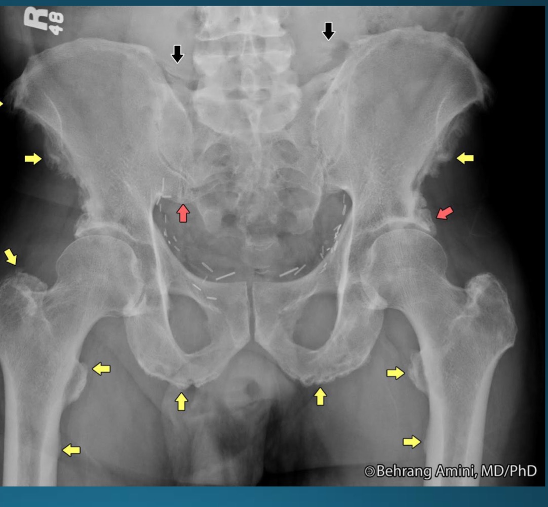 <p>what is this radiographic feature associated with? </p>