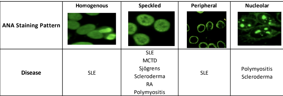 <p><u>Homogenous</u>&nbsp;: Lupus</p><p><u>Peripheral</u>&nbsp;: Lupus</p><p><u>Speckled</u></p><p>• Lupus</p><p>• Scleroderma</p><p>• RA</p><p>• Mixed connective tissue </p><p>• Sjogren</p><p>• Polymyositis</p><p><u>Nucleolar</u>&nbsp;: Scleroderma or Polymyositis</p>