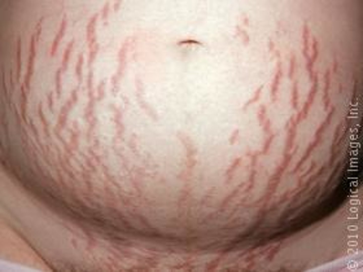 <p>Atrophy (secondary lesion)</p>