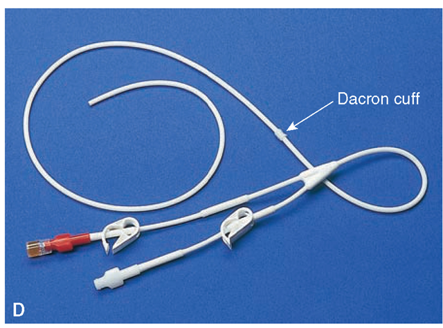 <p>b. To help prevent catheter migration or accidental removal</p><p><strong><sub><sup>Procedural Consideration:</sup></sub></strong><span><sub><sup> The cuff helps to prevent the catheter from migrating inward or being pulled out.</sup></sub></span></p>