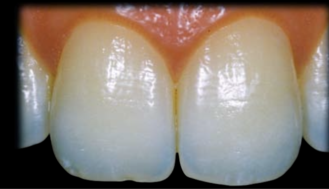 <ul><li><p>Type III Opalescent Layer reveals diffused type of opalescence that is randomly distributed at the incisal third.</p></li><li><p>4% of patients exhibit Type III Opalescent Layer.</p></li></ul><p></p>