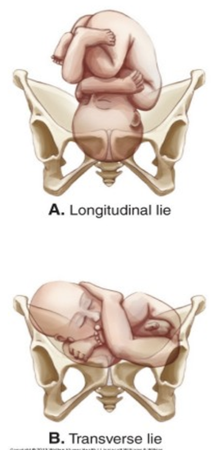 <p>relationship of fetal spine to mother’s spine (cephalocaudal)</p><ul><li><p>longitudinal - vertical (parallel to maternal spine)</p><ul><li><p>cephalic</p></li><li><p>breech</p></li></ul></li><li><p>transverse - horizontal</p><ul><li><p>shoulder- always C/S </p></li></ul></li></ul>