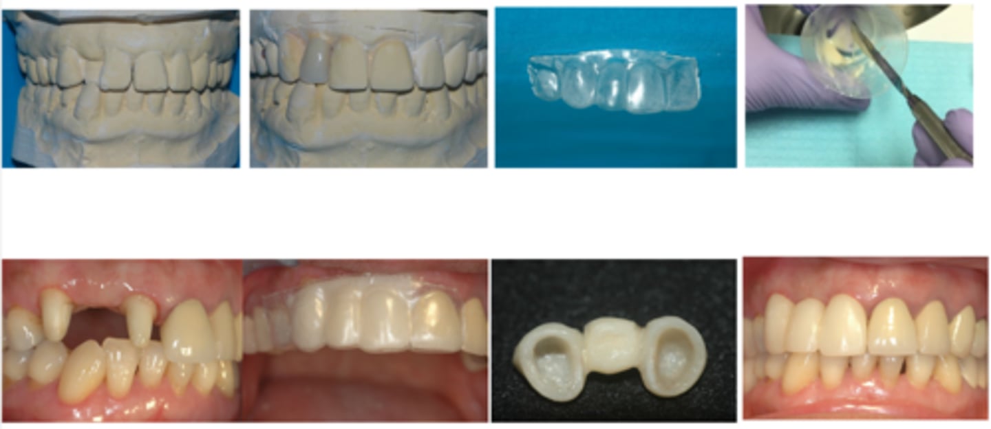 <p>Which temp fabrication technique is shown here?</p>
