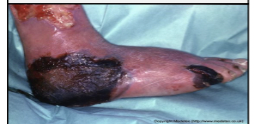 <p>Gray-to-black discoloration of skin due to skin death from a burn, ulcer, wound, or poor blood supply.</p>