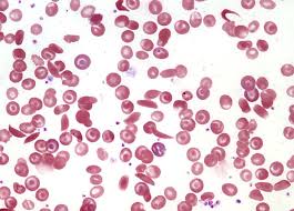 <p>is a biconcave disc-shaped cell that carries oxygen from the lungs to the body's tissues and returns carbon dioxide from the tissues back to the lungs.</p>