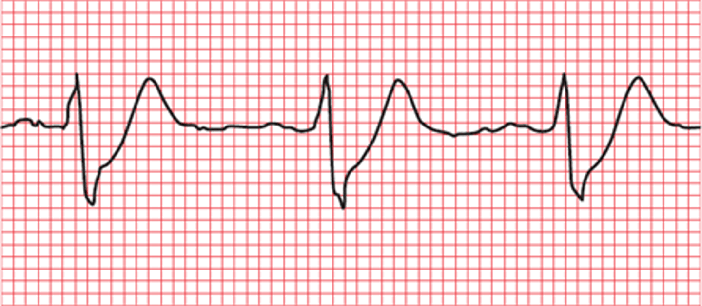 <p>- tall, symmetric waves in the precordial leads</p><p>- upsloped ST segment depression &gt;1 mm at the J point in the precordial leads</p><p>- absence of ST elevation</p><p>- ST segment elevation (0.5-1 mm) in aVR</p>