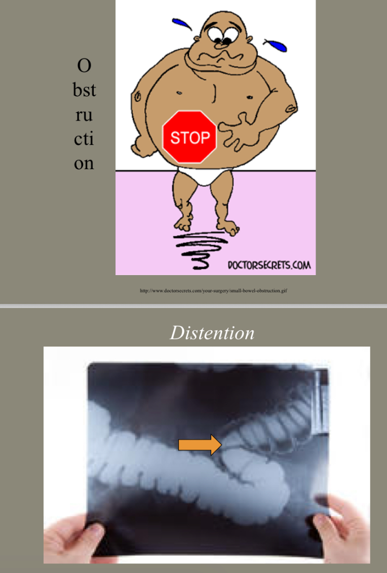 <p>Intestinal contents, fluid, gas accumulate above the obstruction</p>