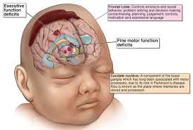 <p><strong>The nurse assessing a renal failure patient for encephalopathy caused by high uremic levels may observe which of the following clinical manifestations?</strong></p><p>A) Severe chest pain with pericardial friction rub on auscultation</p><p>B) Stiff immobile joints and contractures</p><p>C) Loss of recent memory and inattention</p><p>D) Pruritus with yellow hue to skin tone </p>