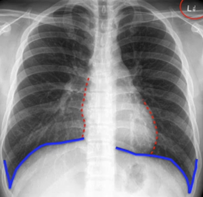 <p>When would the Costophrenic angle go from sharp to blunted?</p>