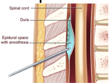 <p>Epidural injection is possible because of the true space between vertebrae and dura mater</p>