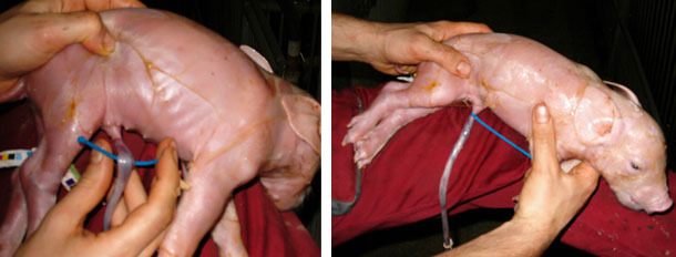 <p>Clamping the umbilicus 2-3 cm from the skin with a ligature or umbilical clip, followed by disinfection</p>