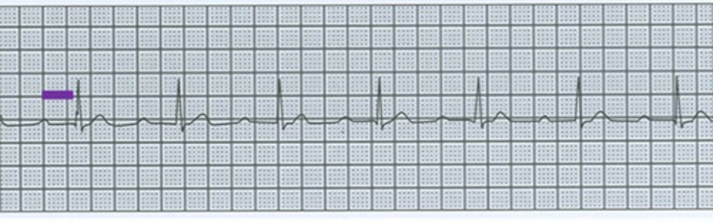 <p>What arrhythmia is this?</p>