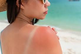 <p>sunburn</p>