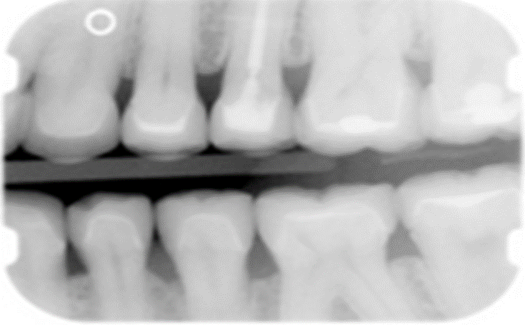 <p><span>What type of restoration is on tooth #20?</span></p>