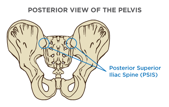 <p>PSIS (Posterior Superior Iliac Spine)</p>