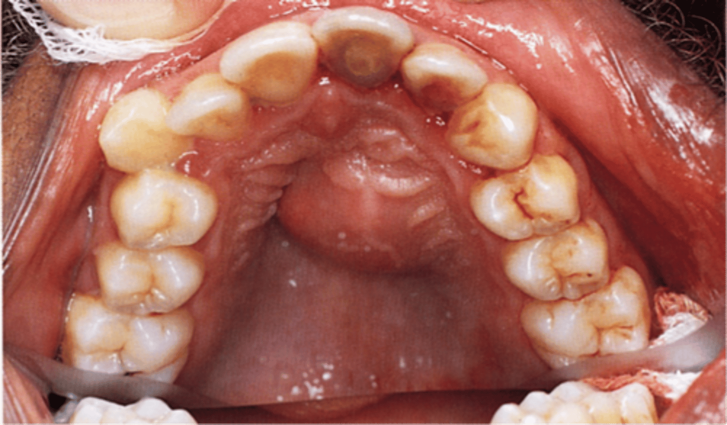 <p>parulis/sinus track</p>