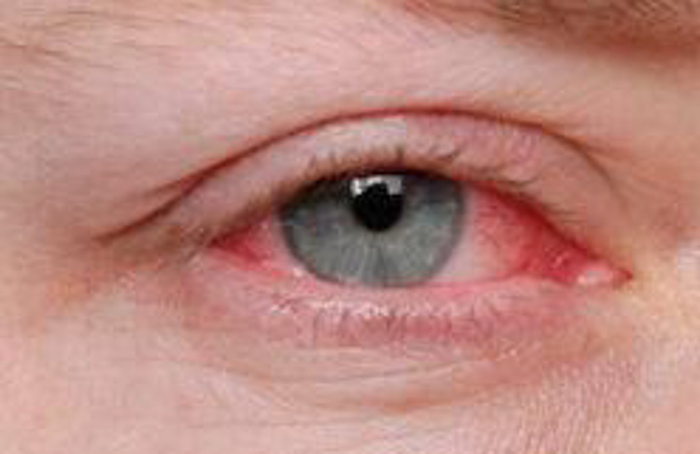 <p>Viral Conjunctivitis</p>