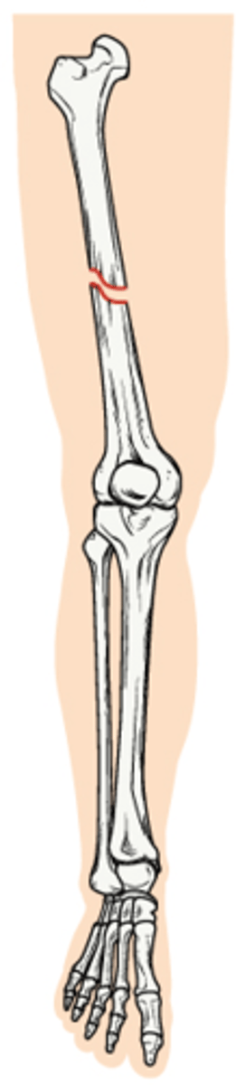 <p>Occurs at an angle across the bone</p>