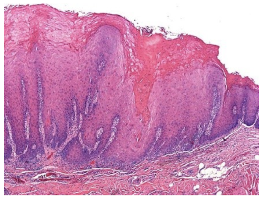 <p>A 65-year-old man presented with a chief complaint of painless growth on the right corner of the mouth for the last two years. The patient had a history of tobacco chewing 3-4 times a day for the last 30 years. On physical examination, an exophytic, white mass was seen intra orally involving the right buccal mucosa and extending extra orally to the corner of mouth. The lesion was approximately 4 x 4 cm in size, well-defined and elevated from adjacent mucosa with irregular and firm margins. An incisional biopsy of the mass was performed. The microscopic appearance of the biopsy specimen is shown in the attached figure. Which of the following is the most likely diagnosis?</p><p>&nbsp;&nbsp;</p><p>Erythroplakia</p><p>&nbsp;</p><p>Oral hairy leukoplakia</p><p>&nbsp;</p><p>Pyogenic granuloma</p><p>&nbsp;</p><p>Squamous cell carcinoma</p><p>&nbsp;</p><p>Verrucous carcinoma</p>