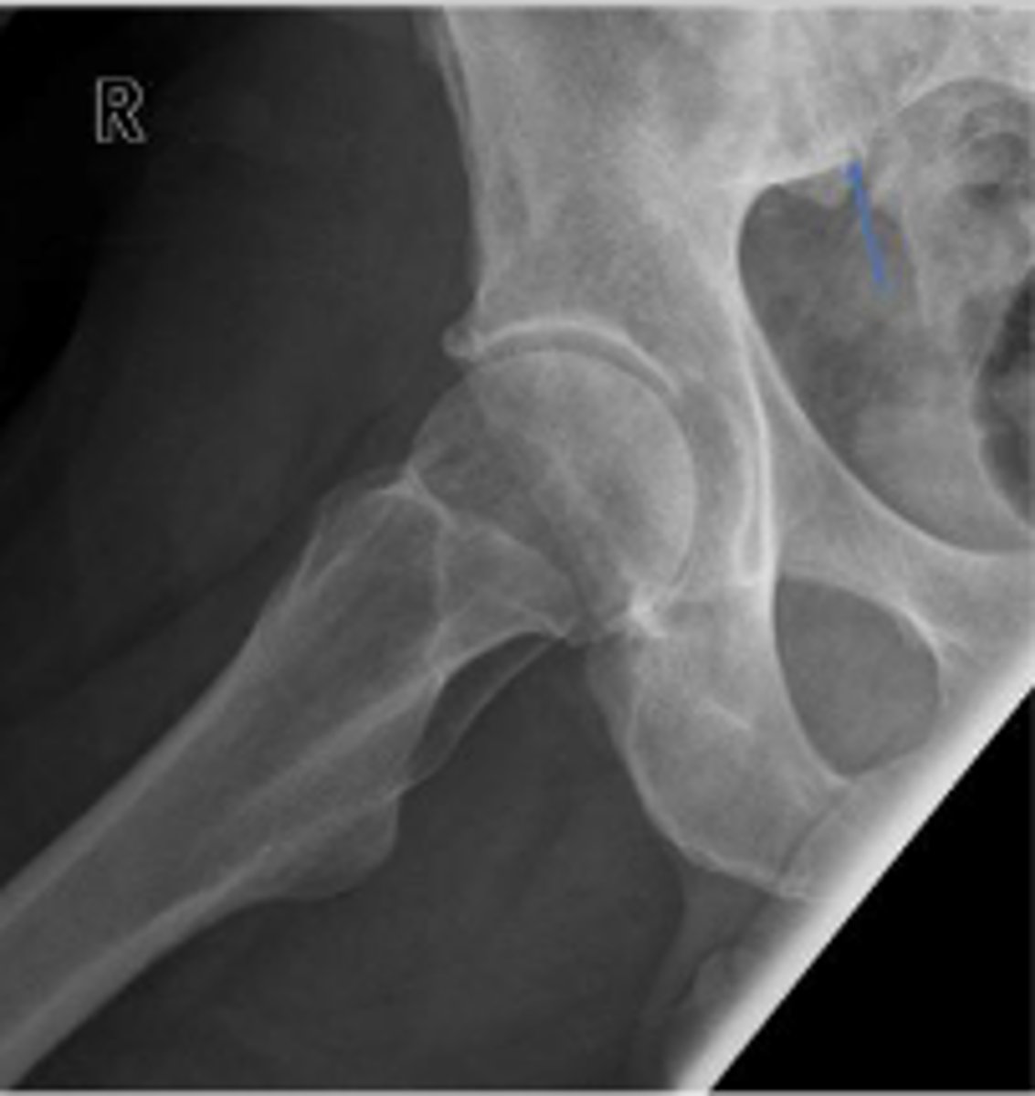 <p>What joint space is the arrow pointing to?</p>