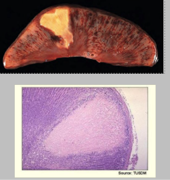 <p>What is this type of necrosis, its causes, and describe the gross and histo features</p>