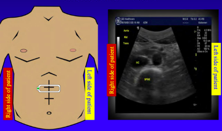 When the ultrasound probe is transverse (cross-sectional) the right of the picture is _______