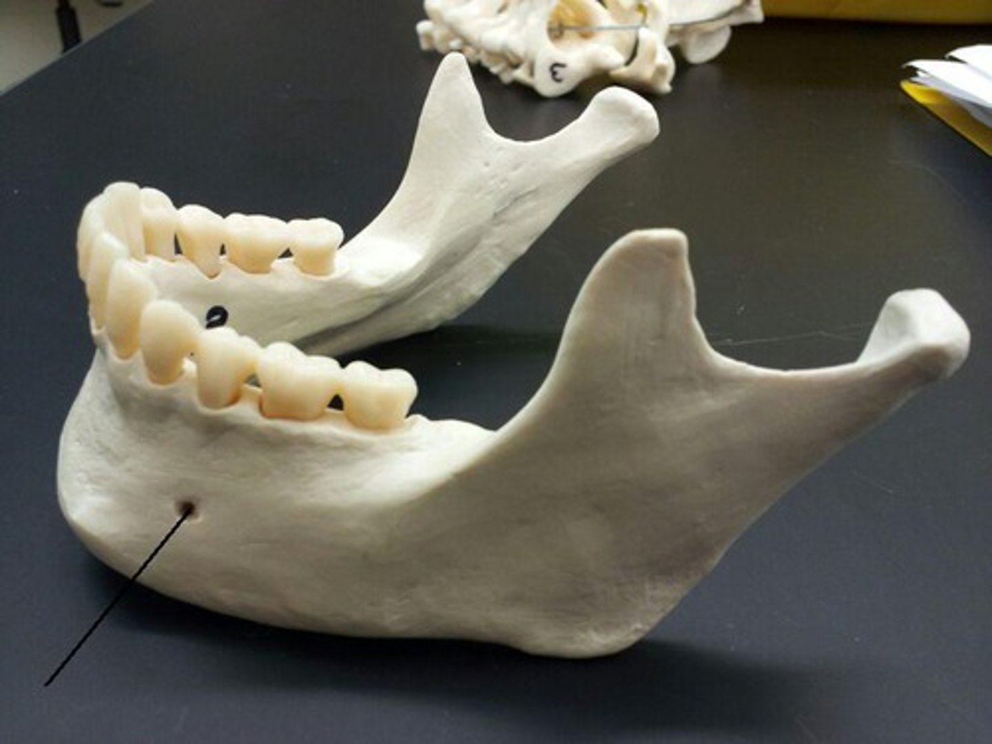 <p>one of two holes located on the anterior surface of the mandible. It permits passage of the mental nerve and vessels.</p>