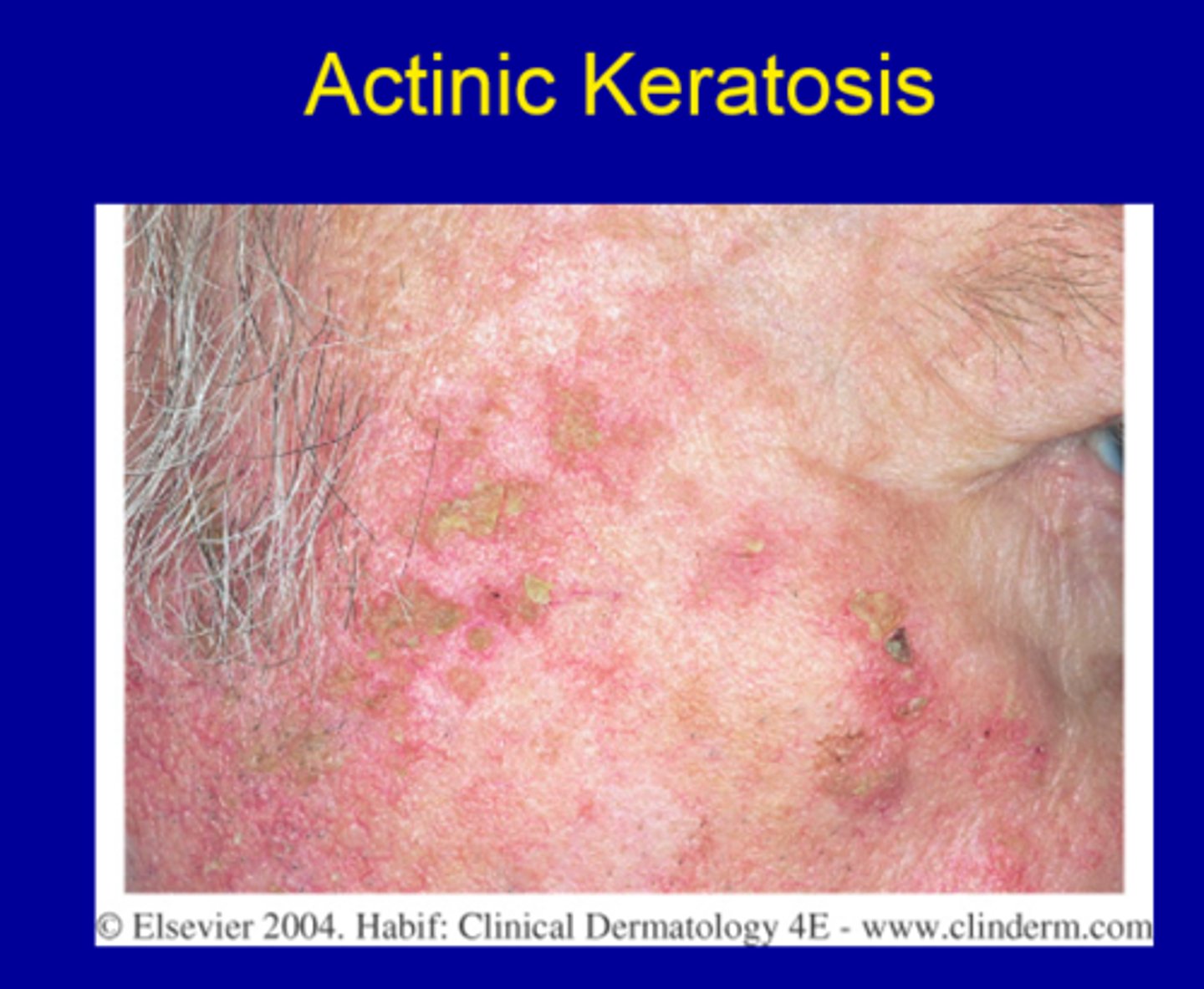<p>reddish plaque with scaly white surface </p><p>• dysplasia - precancerous</p><p>• sun exposure </p><p>• common location: face </p><p>• population: adults over 40</p>