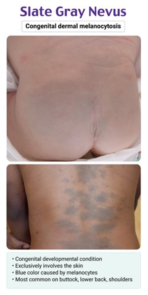 <p>slate gray nevus (aka congenital dermal melanocytosis) → benign; can disappear in a few yrs</p>