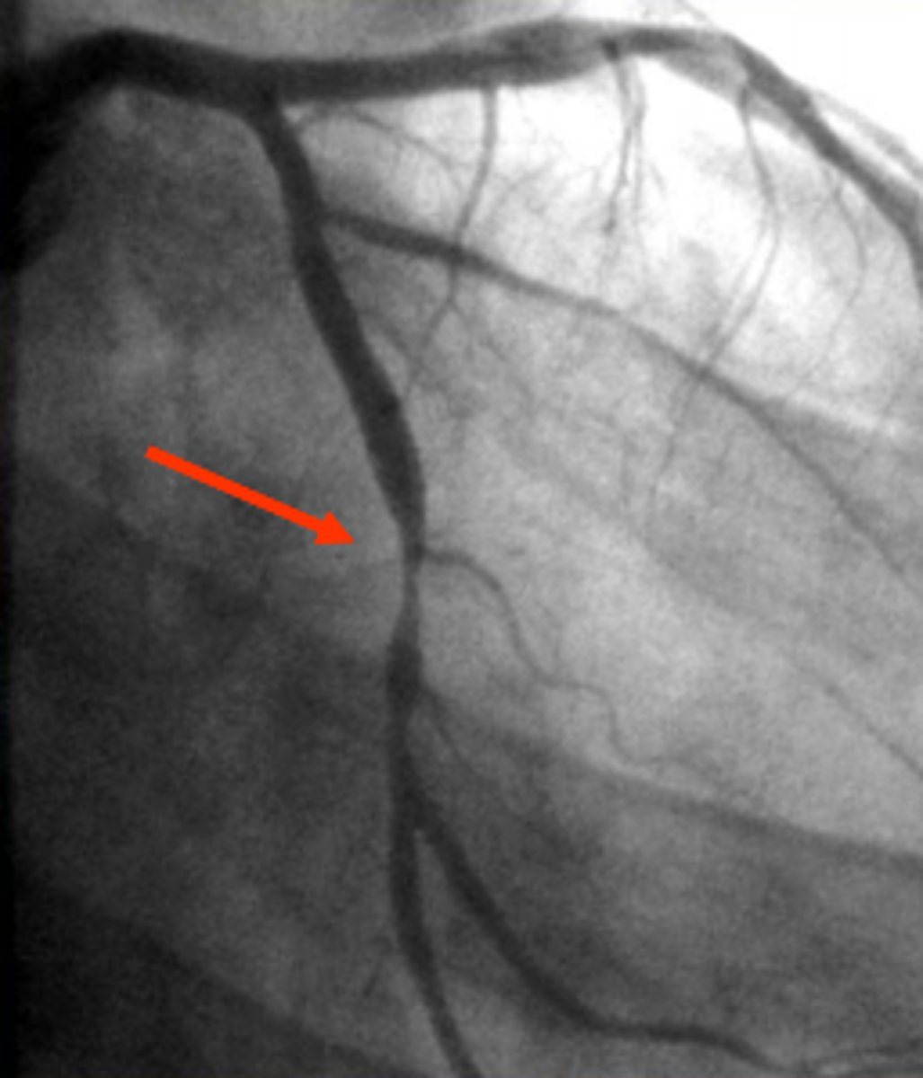 <p>Radiographic image of a blood vessel</p>