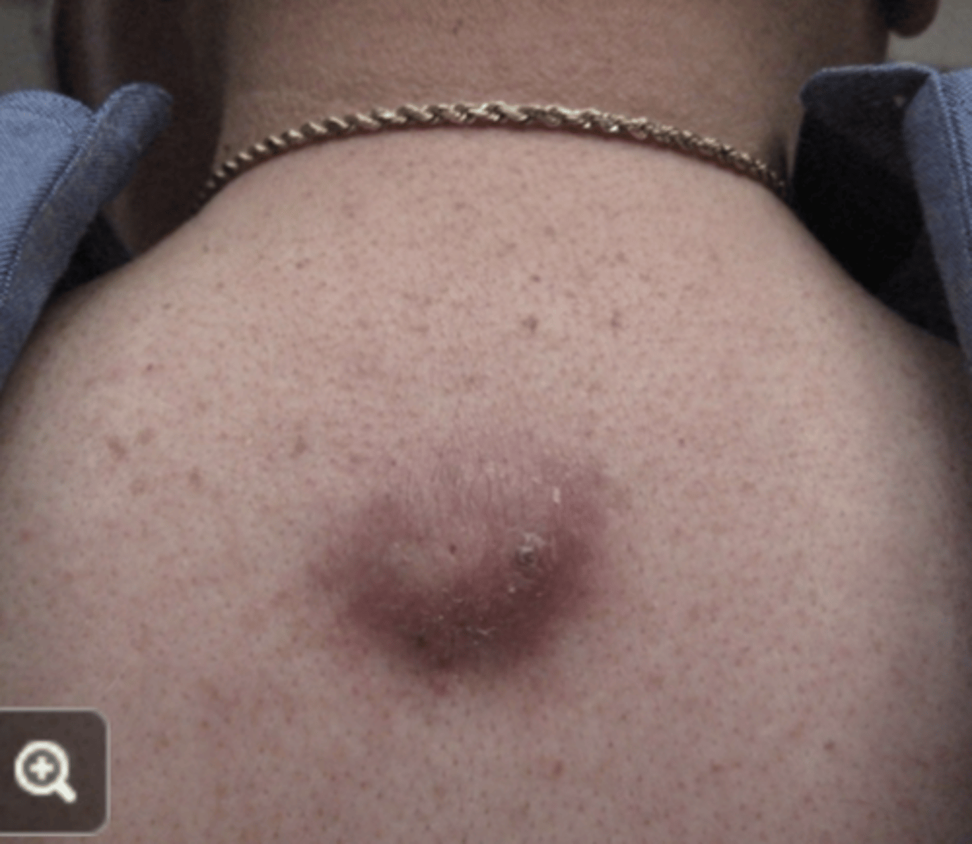 <p>How is inflamed EIC differentiated from an abscess?</p>