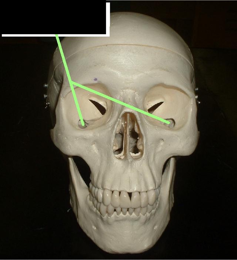 <p>A teardrop-shaped crack in the lower eye socket</p>