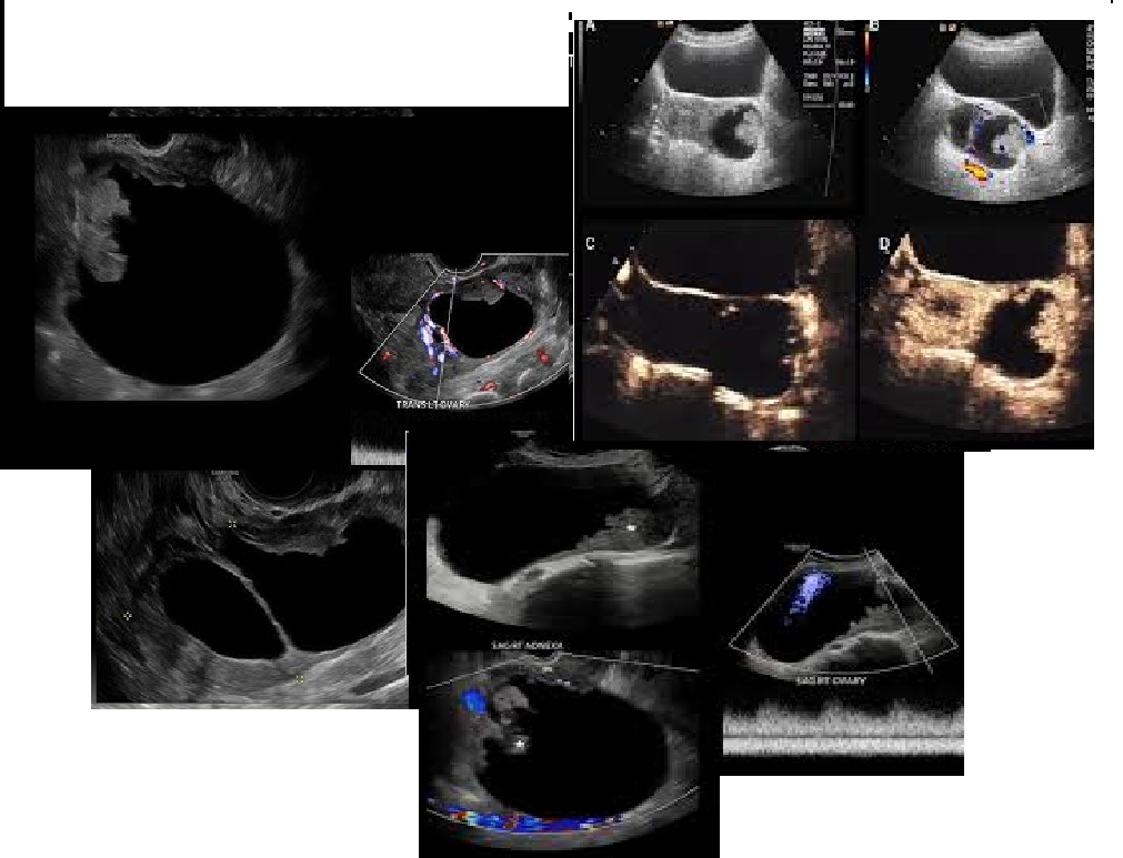 <p>MC ovarian MALIGNANCY</p><p></p>