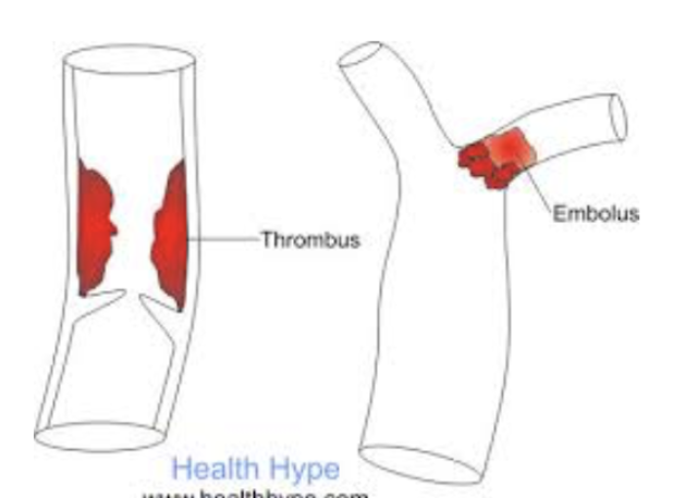 <p></p><ol><li><p><strong>Thrombus</strong></p><ul><li><p>Clot that develops and persists in unbroken blood vessel</p></li><li><p><span style="color: red;"><strong>Risk factors</strong></span> → May block circulation, leading to tissue death</p></li></ul></li><li><p><strong>Embolus</strong> </p><ul><li><p>Thrombus freely floating in bloodstream </p></li></ul></li><li><p><strong>Embolism</strong></p><ul><li><p> Embolus obstructing a vessel (<span style="color: green;"><strong>pulmonary or cerebral emboli</strong></span>) </p></li><li><p><span style="color: red;"><strong>Risk factors</strong></span> → atherosclerosis, inflammation, slowly flowing blood or blood stasis for immobility </p></li></ul></li></ol><p></p>